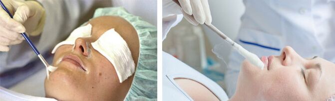 peeling jeung cryotherapy pikeun rejuvenation kulit