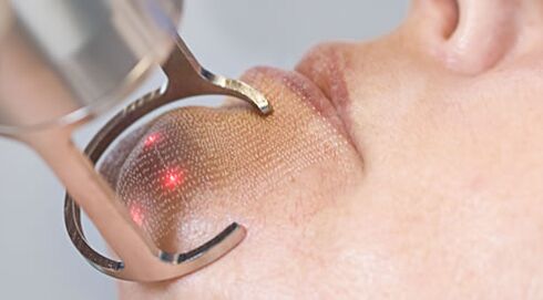 Jalanna prosedur pikeun réparasi kulit wajah rai laser